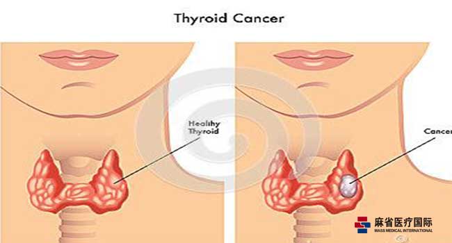 甲狀腺,腫瘤,手術(shù)后,注意事項(xiàng)