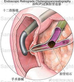 ercp檢查術(shù)后注意事項(xiàng)