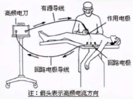 手術(shù)使用電刀注意事項(xiàng)