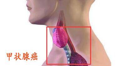 甲狀腺腫瘤切除手術(shù)后飲食注意事項(xiàng),甲狀腺腫瘤切除手術(shù)后注意事項(xiàng),做了甲狀腺腫瘤手術(shù)后注意事項(xiàng)
