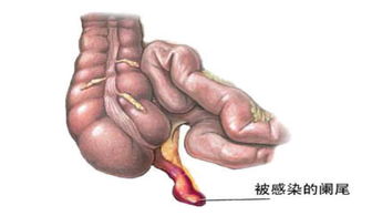 闌尾炎術后注意事項,闌尾炎注意事項和飲食,預防闌尾炎注意事項