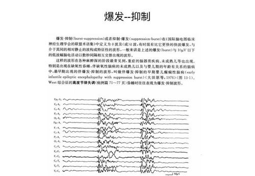 正常腦電圖基礎(chǔ)知識(shí)